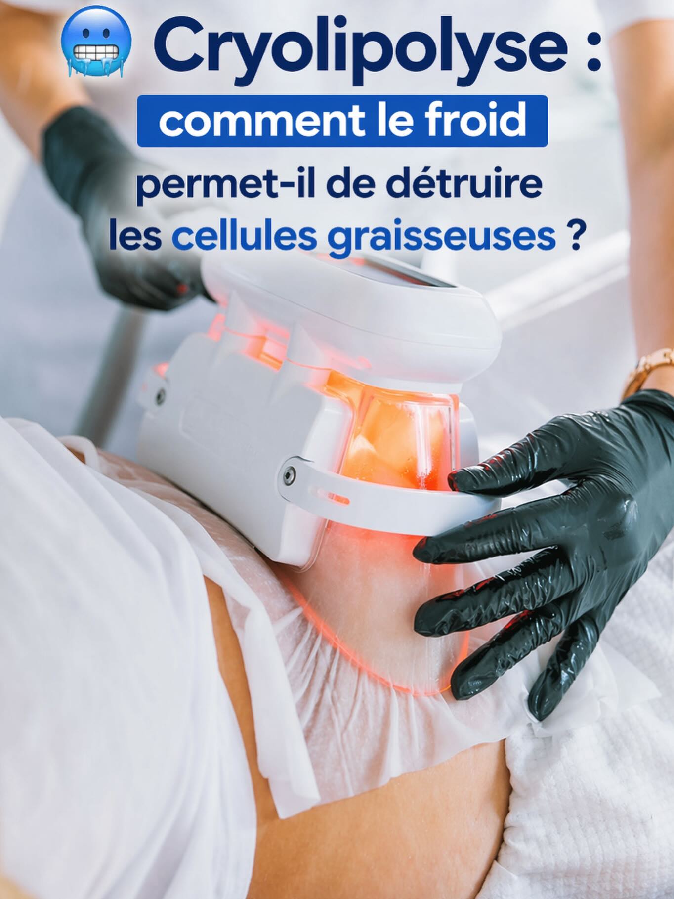 Cryolipolyse technologie référence réduction graisse