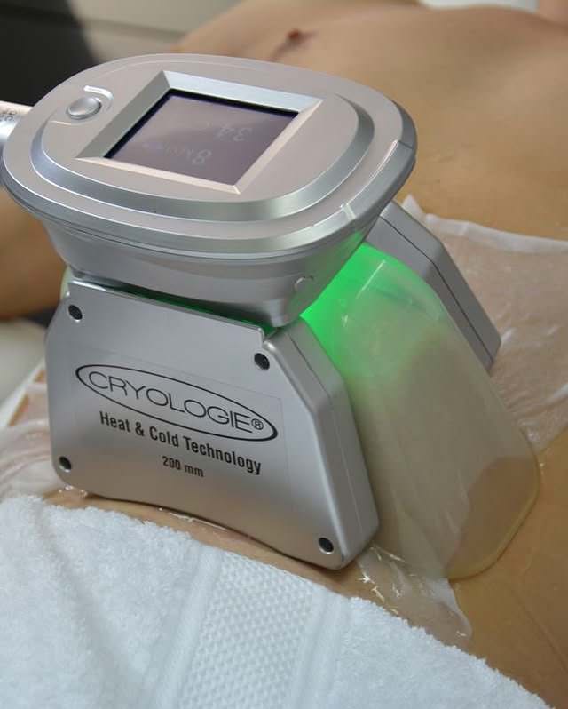 Appareil de cryolipolyse en action sur l'abdomen